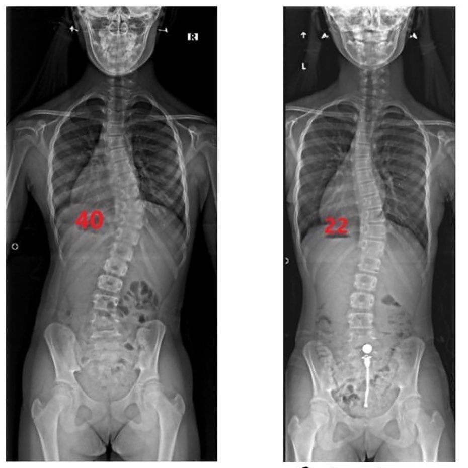 Before and after spine X-rays of a patient, side by side