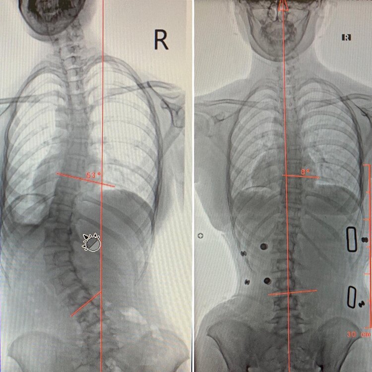 Before and after spine X-rays of a patient with measurement lines