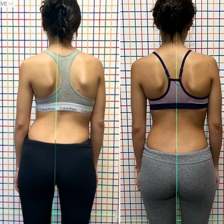 Before and after back photos of a patient standing against a grid