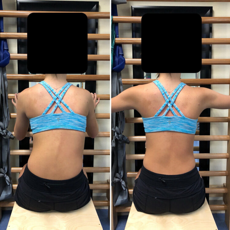 Before and after back photos of a patient in front of wall bars