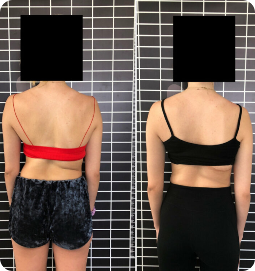 Before and after back photos of a patient standing against a grid, face covered